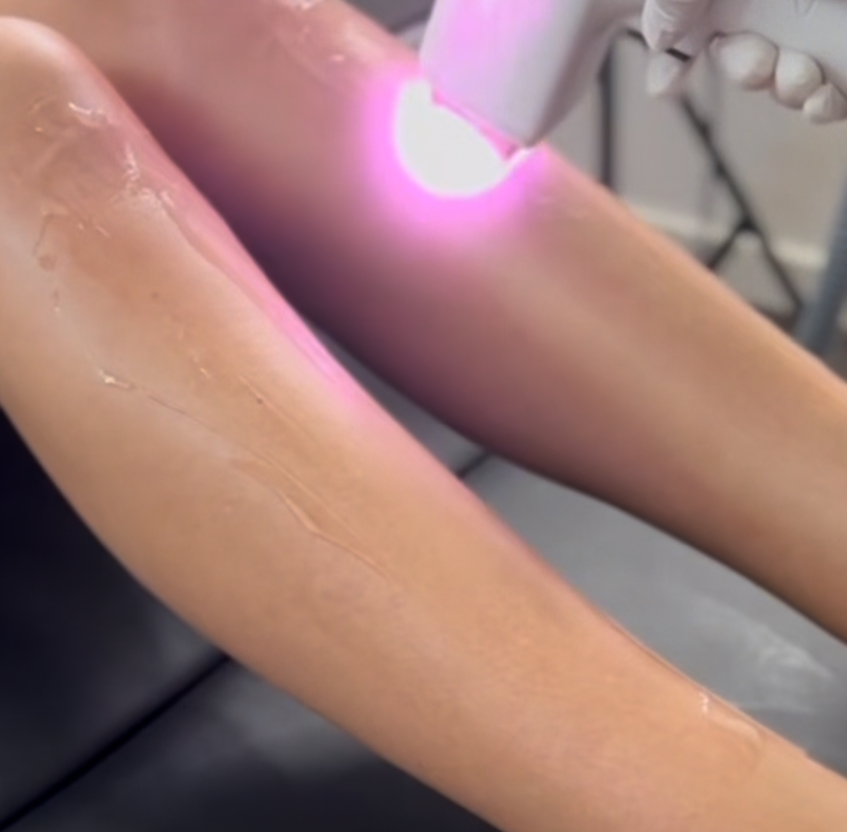 Laser Hair Removal in Preston