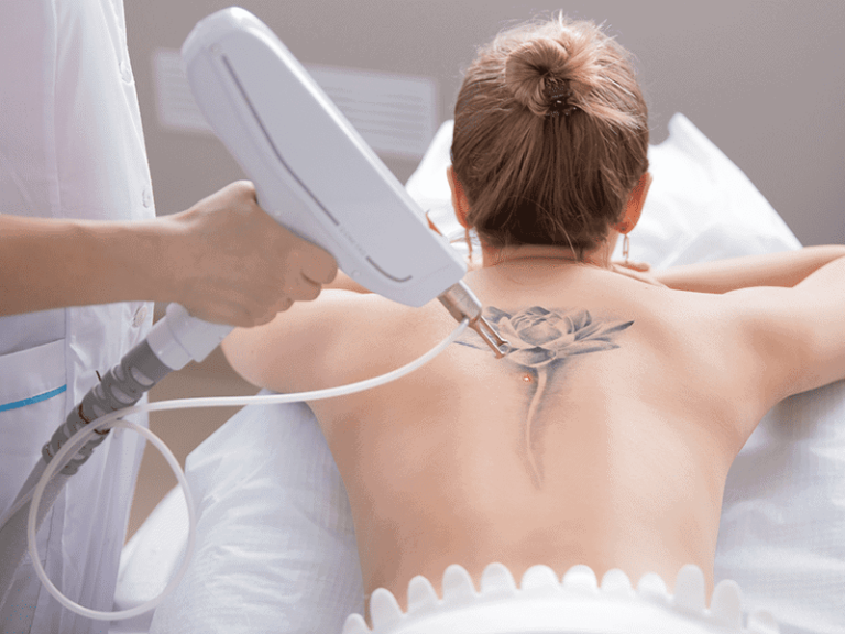 laser tattoo removal preston
