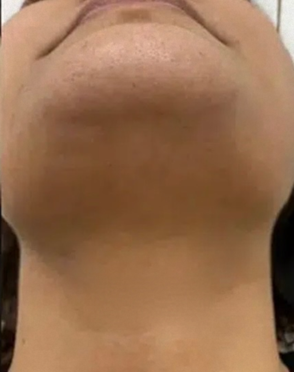 Chin and jawline after laser hair removal