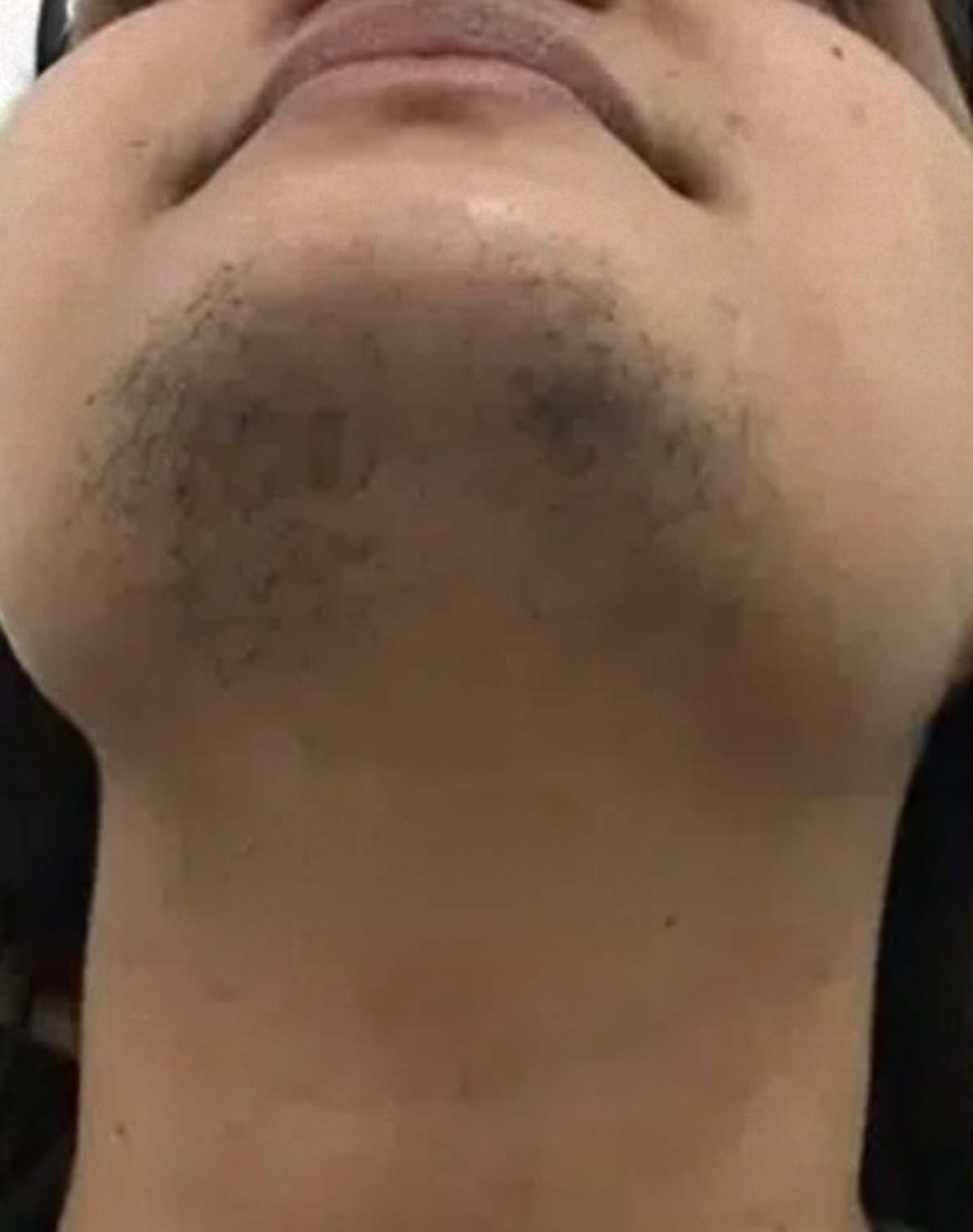 Chin and jawline before laser hair removal
