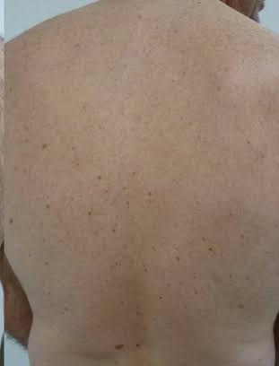After laser hair removal at The Skinician, Preston