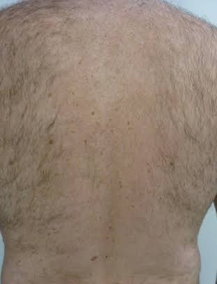 Before laser hair removal at The Skinician, Preston