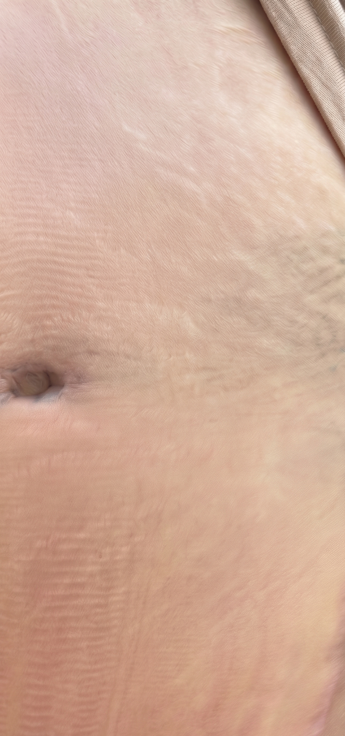 Lower abdomen after laser tattoo removal at The Skinician, Preston