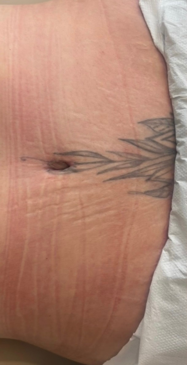 Lower abdomen tattoo before laser removal at The Skinician, Preston
